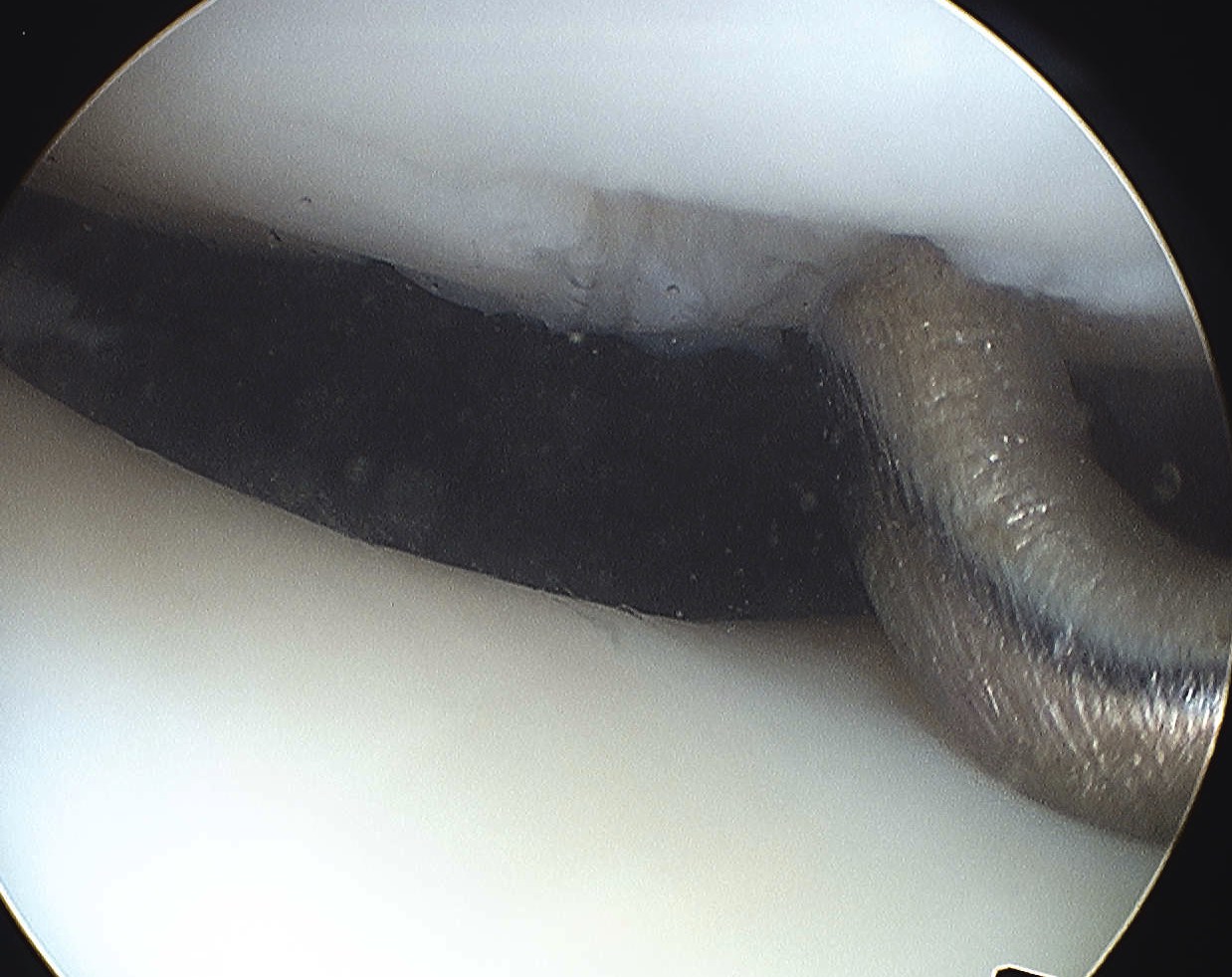 Patella Small Chondral Lesion